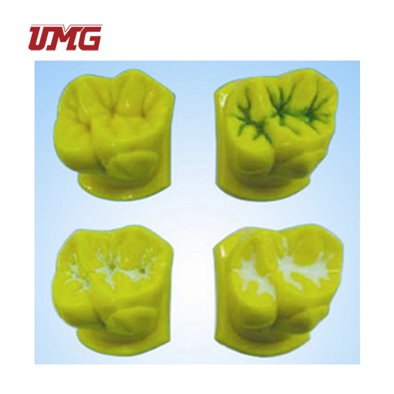 Dental Model Showing The Sealant of Occlusal