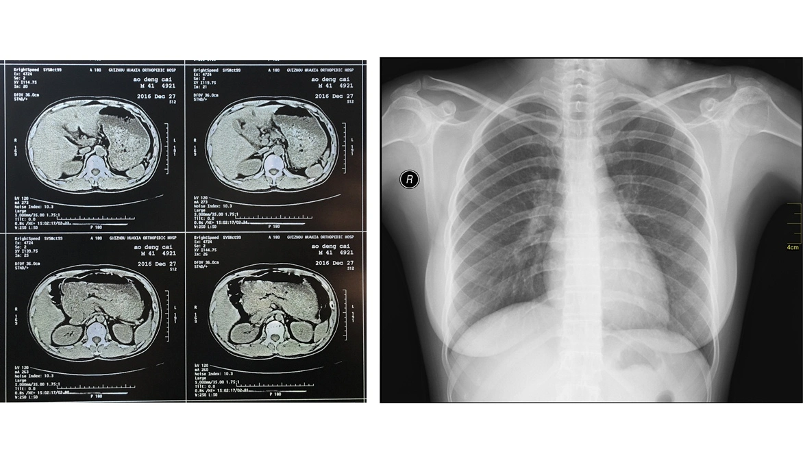 ضباب منخفض 8 × 10 بوصة أزرق الحيوانات الأليفة بنفث الحبر طبي فيلم الأشعة السينية لطابعة Epson