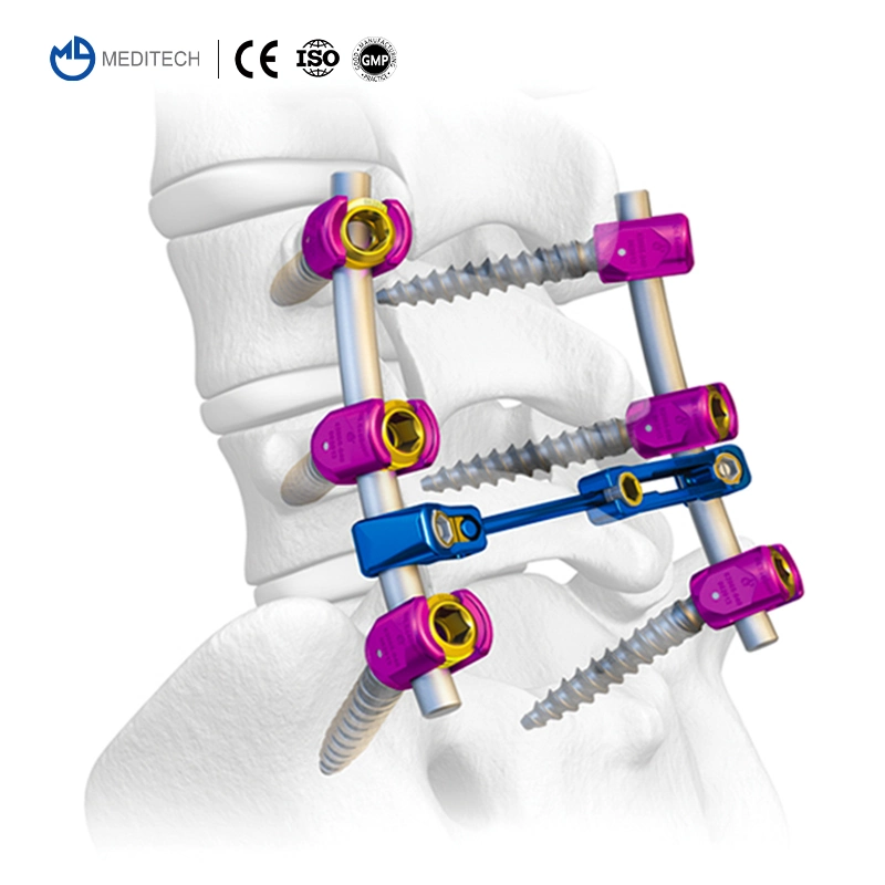 Implante ortopédico Productos médicos 6,0mm sistema de tornillo pediculado de fijación espinal