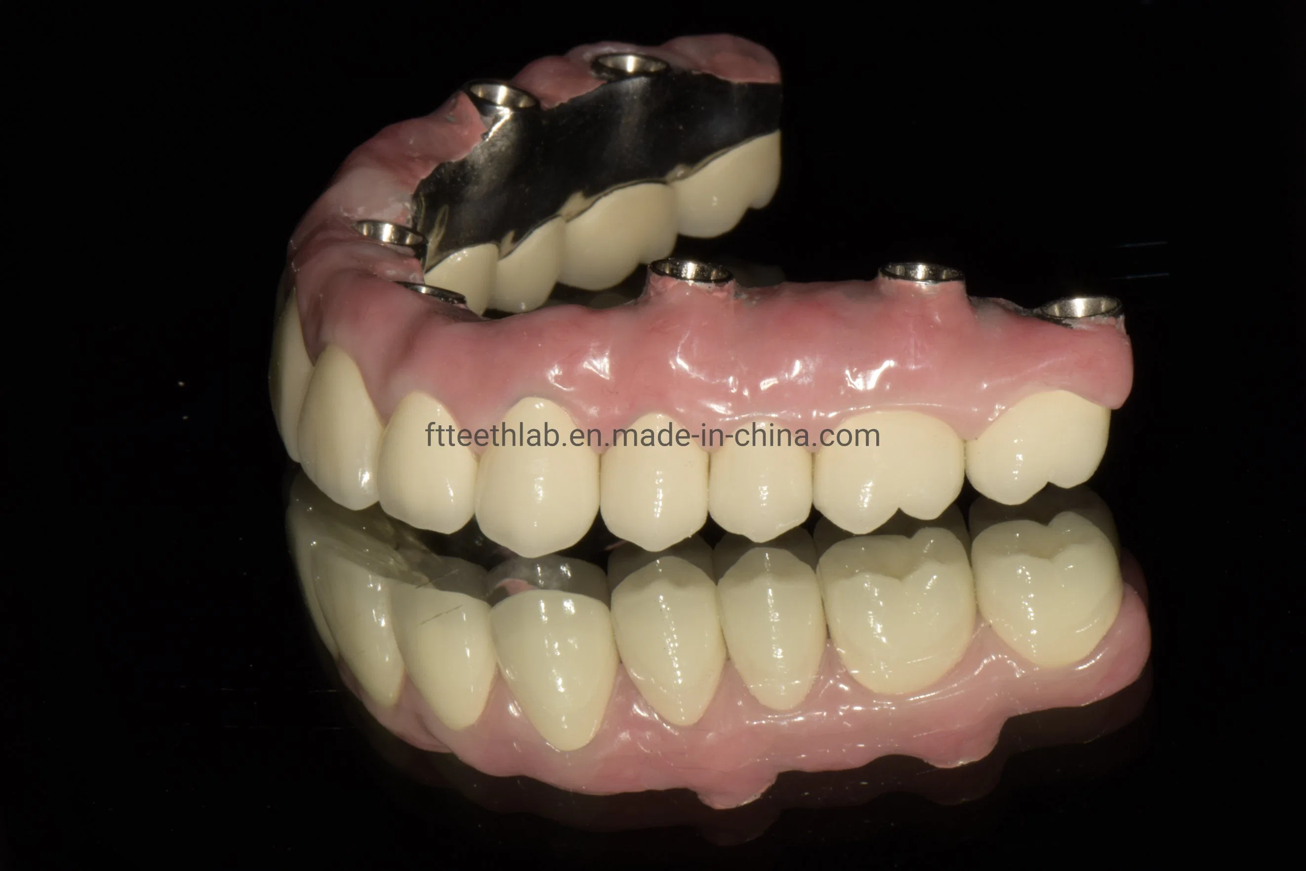 Full Arch Zirconia Screwed Implant Bridge