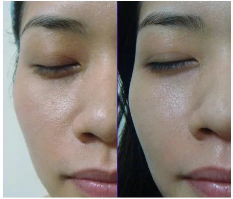 Otesaly Safe Obvious Effect Glutathione Skin Whitening Skin Care Product Mesotherapy Serum Injection