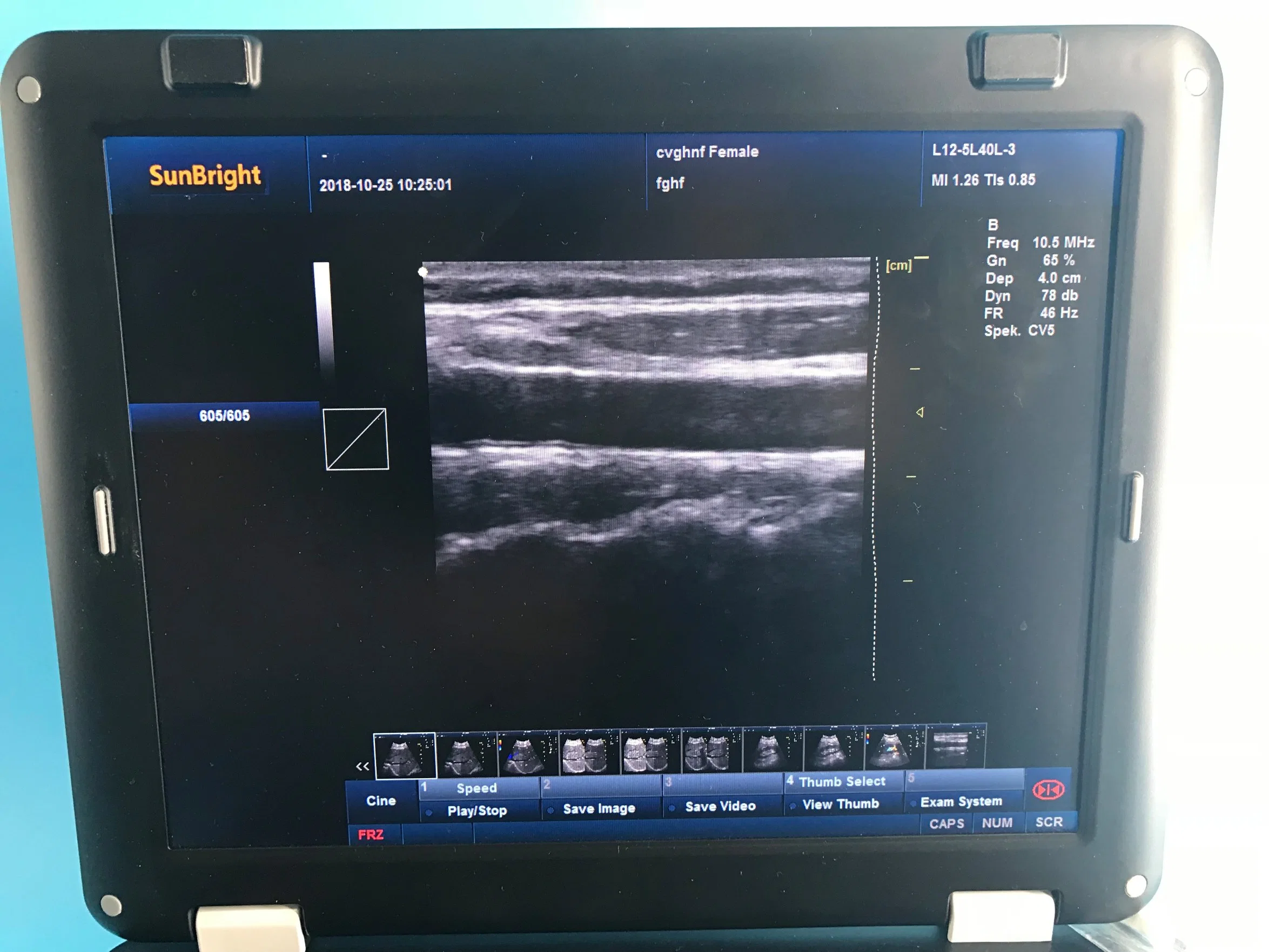 El ultrasonido Doppler para bloqueo del nervio de alta frecuencia Lineal Color Pw Aparato médico