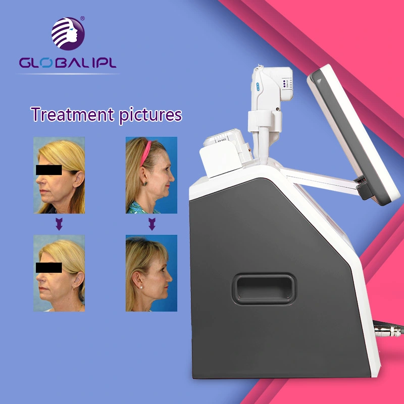 Globalipl Winkle Therapy Skin Tightening 3D Hifu