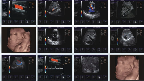 4D Trolley 2 Monitors Color Doppler B Ultrasound Machine