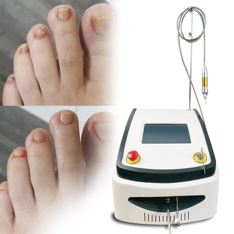 Mejor Venta 980nm Diodo Laser Nails Fungus tratamiento Fisioterapia plantar Eliminación de verrugas