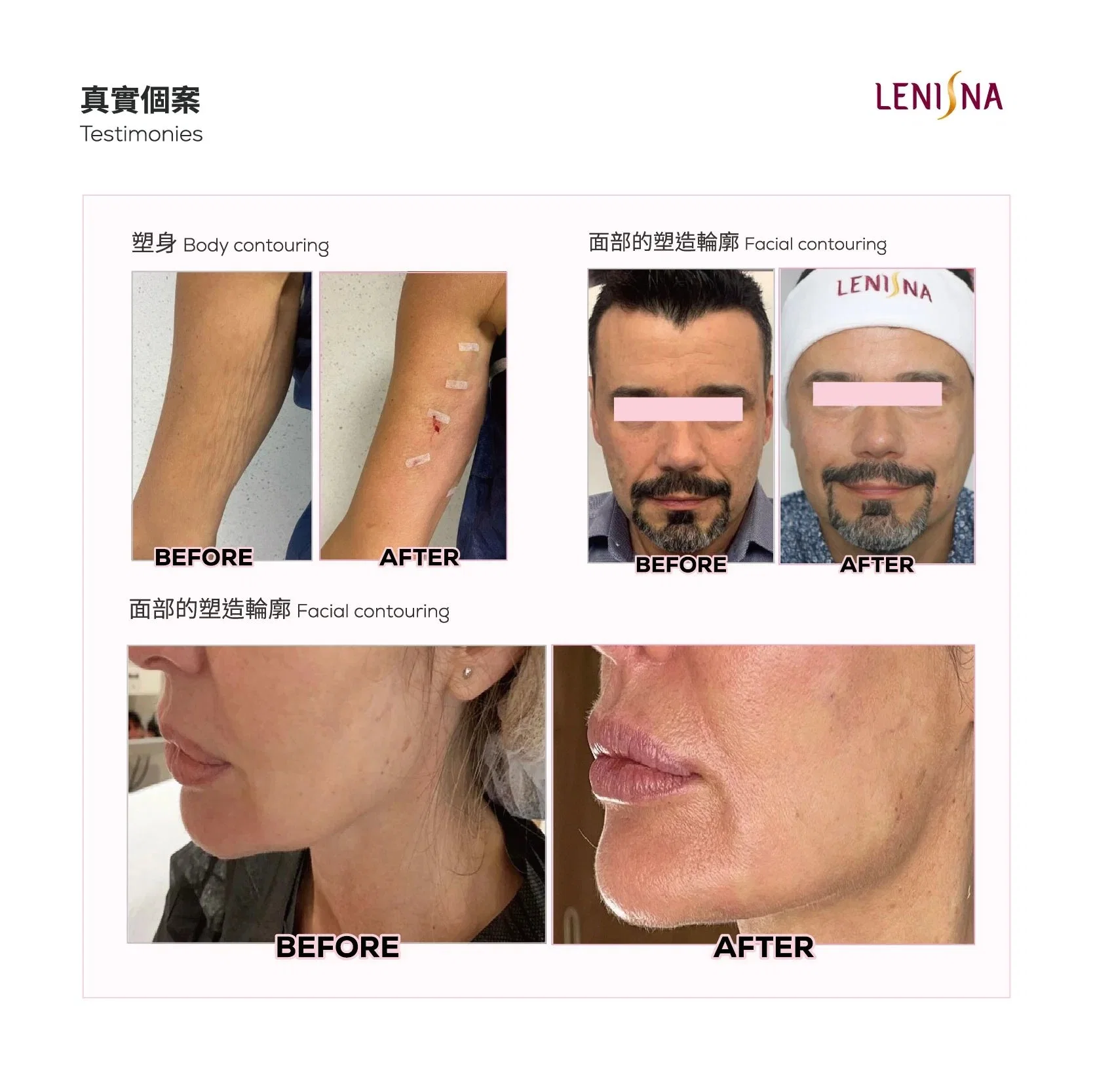 Original Juvelook 50mg Plla Ha Hybrid Filler CE Mark Elastic Rejuvenation Booster Regeneration Repair Olidia