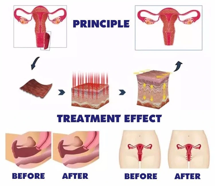 Hot Sales cicatrizes Remoção Beleza Máquina vaginal aperto CO2 Laser Máquina laser fracionada por CO2 de 10600 nm com returfacing para pele