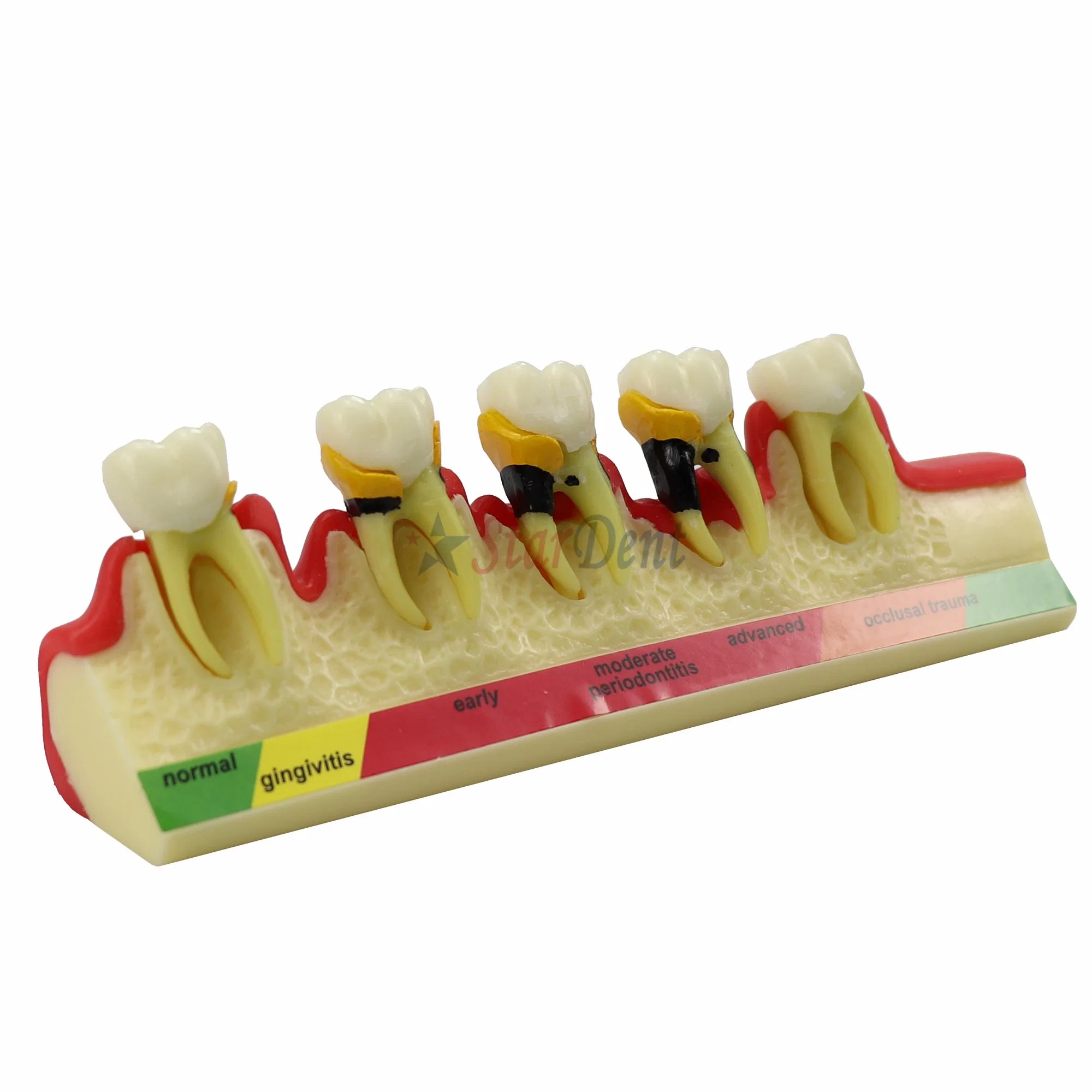 Dental Periodontal Disease Model Demonstrates The Progress of Periodontal Disease Dental Resin Teeth for Teaching