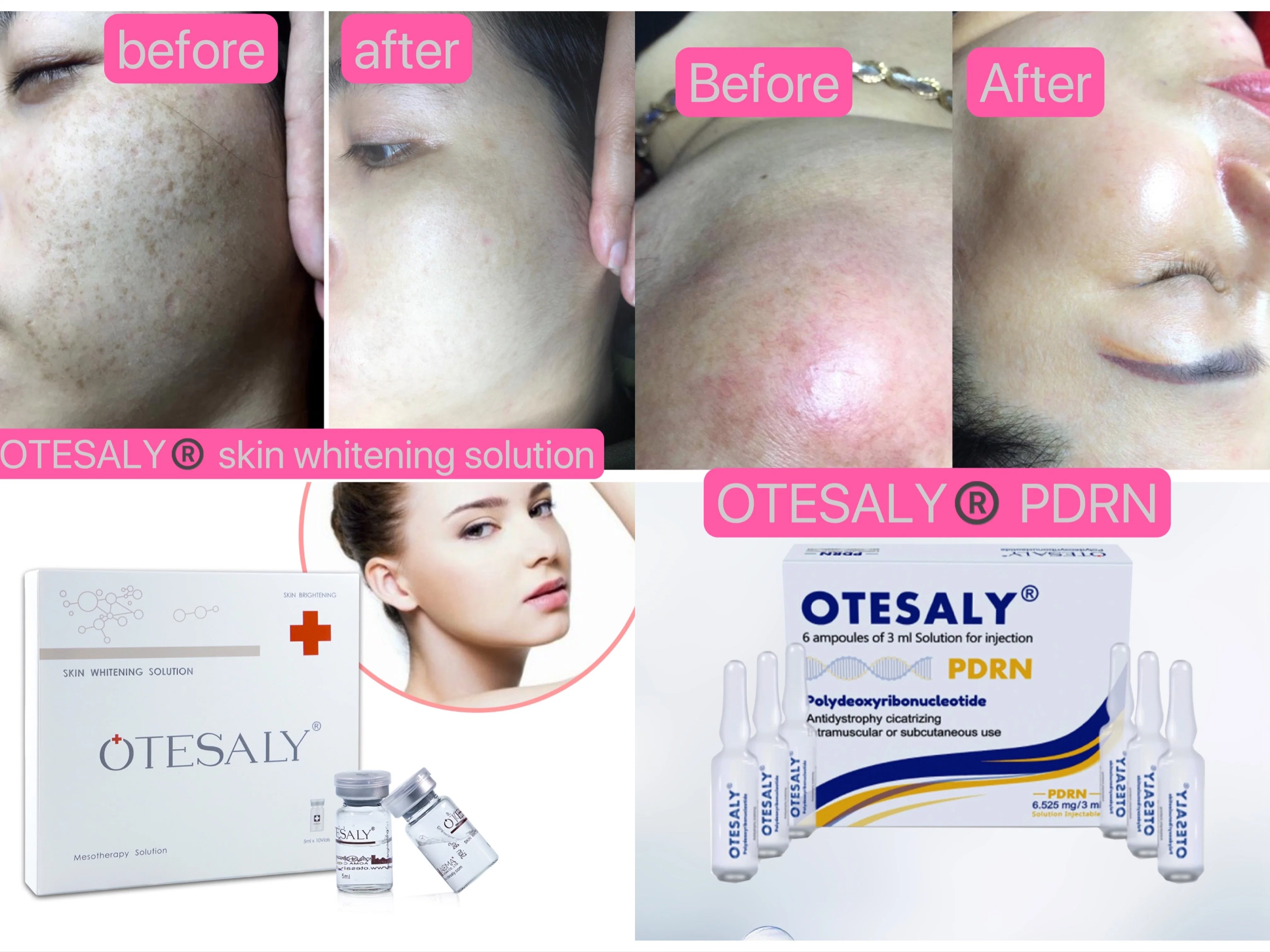 Wholesale/Supplier Otesaly Anti Aging Skin Lifting Salmon DNA Extract Skin Rejuvenation Mesotherapy Ampoules