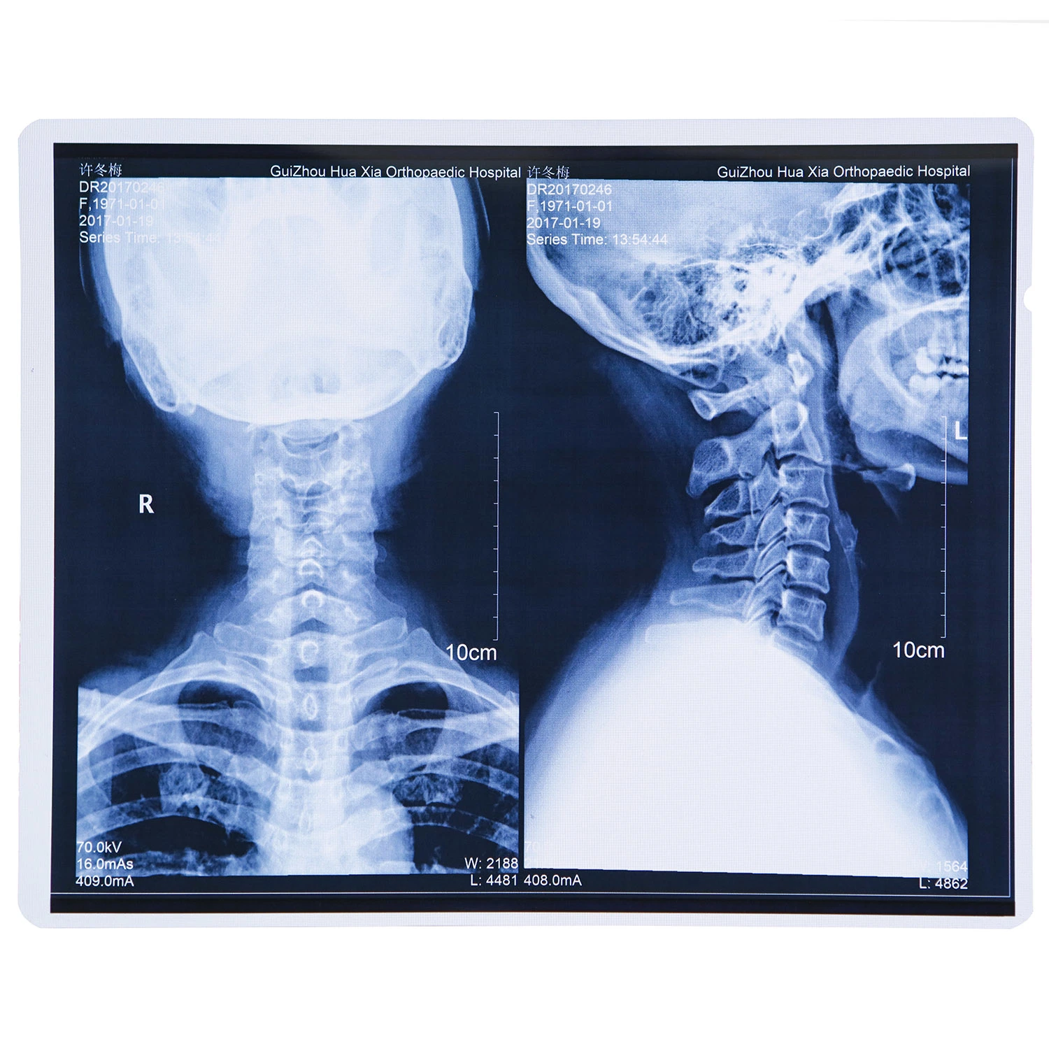 Medical Film Xray Image Printing Use Blue Xray Film Pet Medical Film