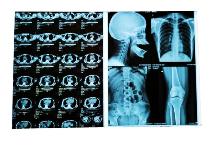 Película azul descartável de alta qualidade branca e laser com base em azul Imprimir película de raios X seca para fins médicos