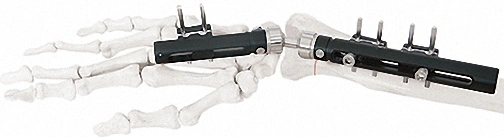 Precio de fábrica de Distal Radius Fixator B External Fixation