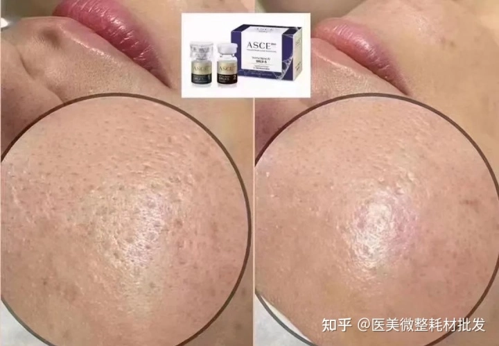 Korea Asce Plus Brighten Skin Cell Regeneration Anti-Aging Asce Plus Derma Signal Kit Srlv-S Lyophilized Powder Acne Exosome Solution Repair Mesotherapy