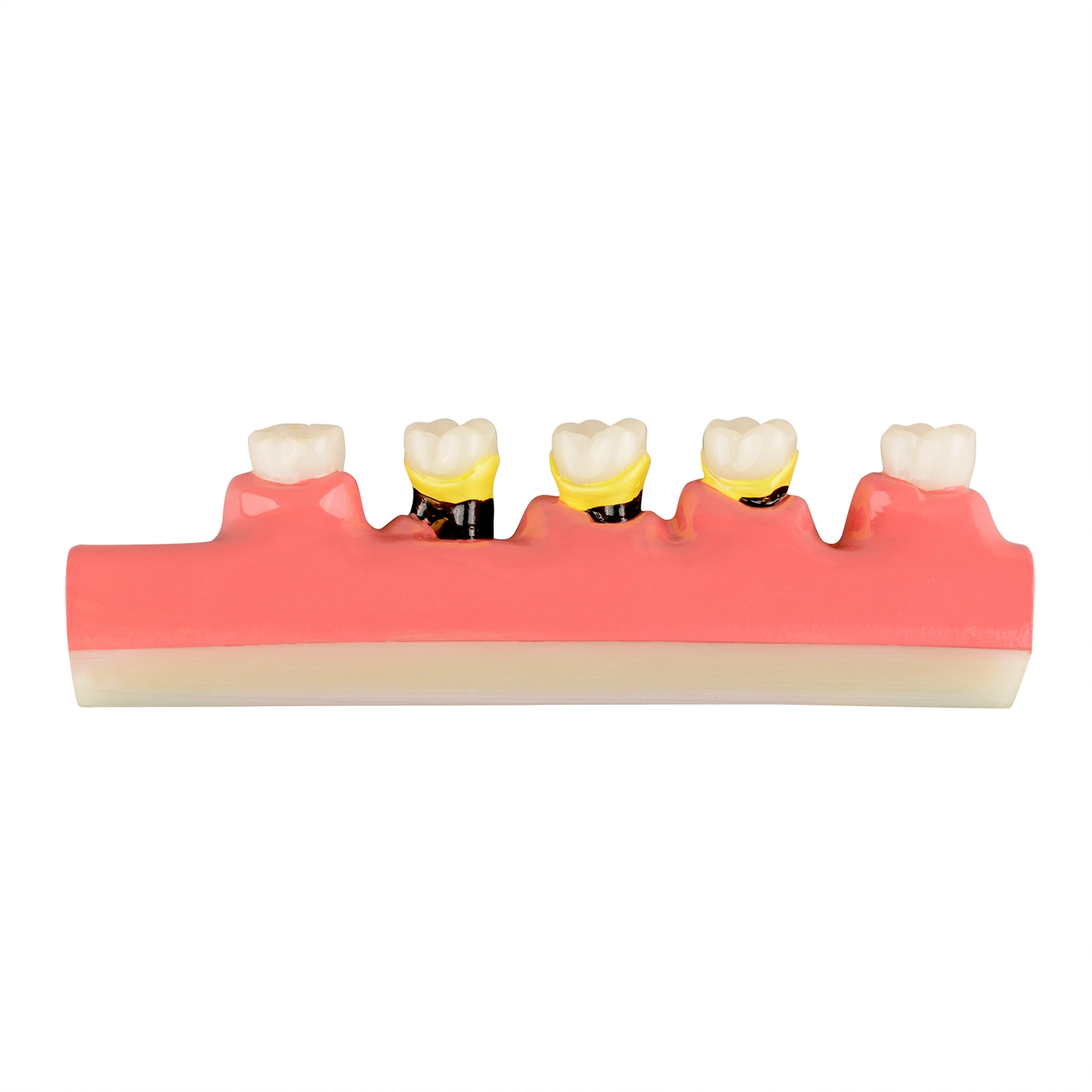 Dental Periodontal Disease Assort Model