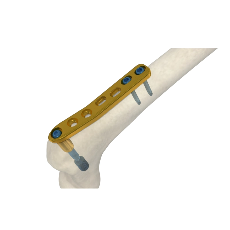 Titan Orthopädische Implantate Proximal Femoral Lateral Locking Knochen Fixationsplatte Chirurgisch