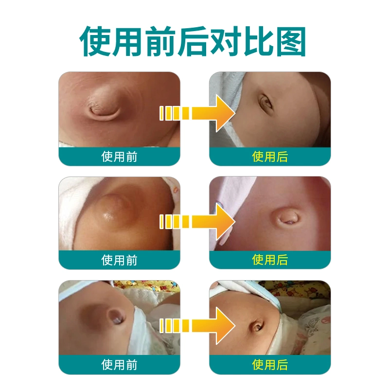 Emblema de hérnia macio e confortável para bebés botão Belly Suporte de hérnia