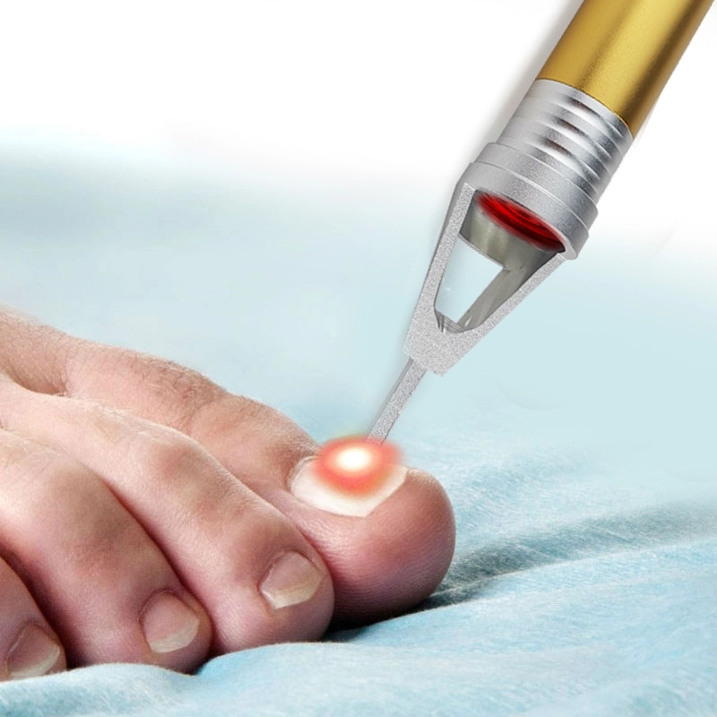 Diode Laser 980nm Nail Fungus Onychomycosis Cure Laser Treatment Device Toenail Fiber Optic Diode Laser Wholesale/Supplier Nail Treatment