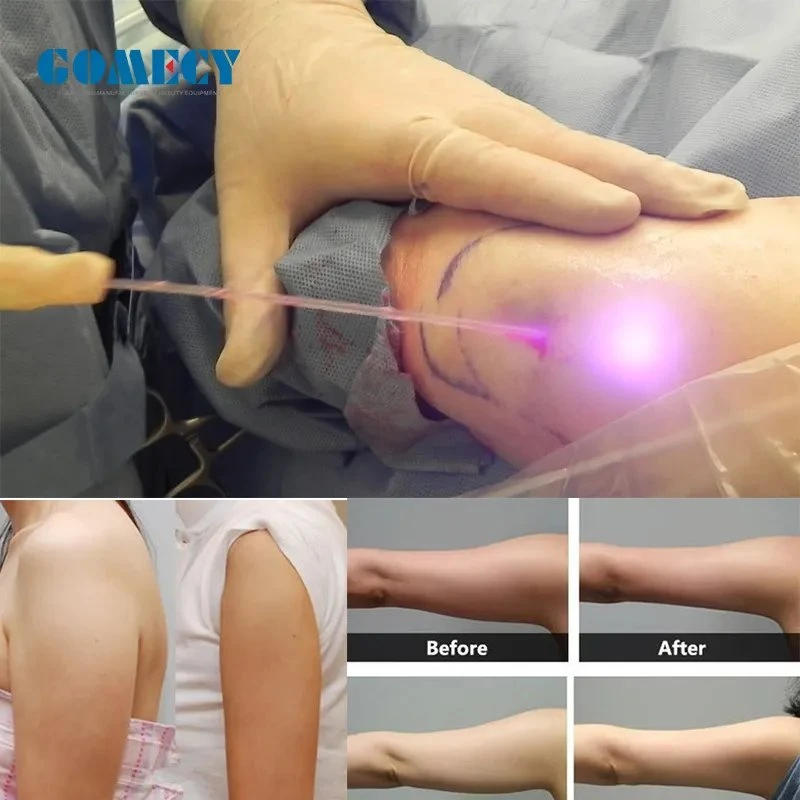 980 1470nm laser Chirurgie vasculaire Fat Endolift de réduction de la machine