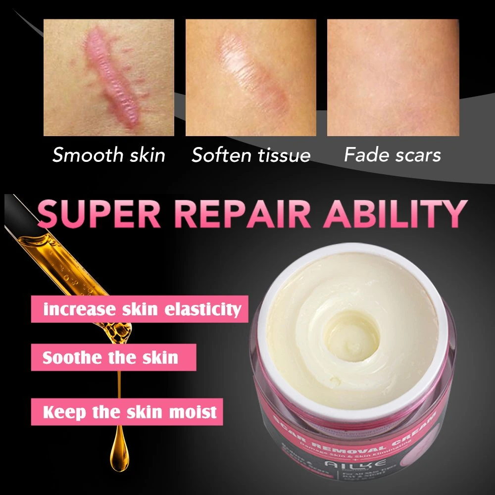 Ailke Smooth Skin Plant Extract Hydrolyzed Collagen Lightening Anti-Acne Removing Stretch Acne Scar Removal Cream