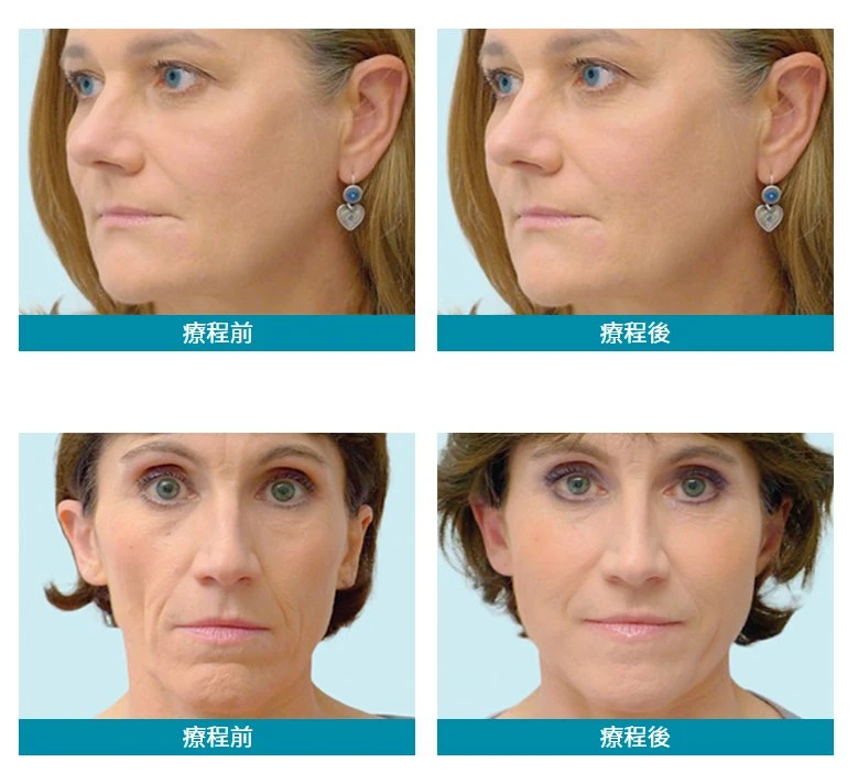 Radiesse Merz ist ein Collagen und Elastin Booster Filler, der mittlere bis tiefe Falten reduziert, die Haut strafft und die Gesichtskonturen neu formt