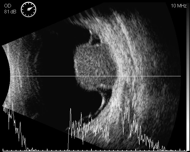 High quality/High cost performance Economic Ultrasound a/B Scan for Ophthalmology (ODM-2100S)