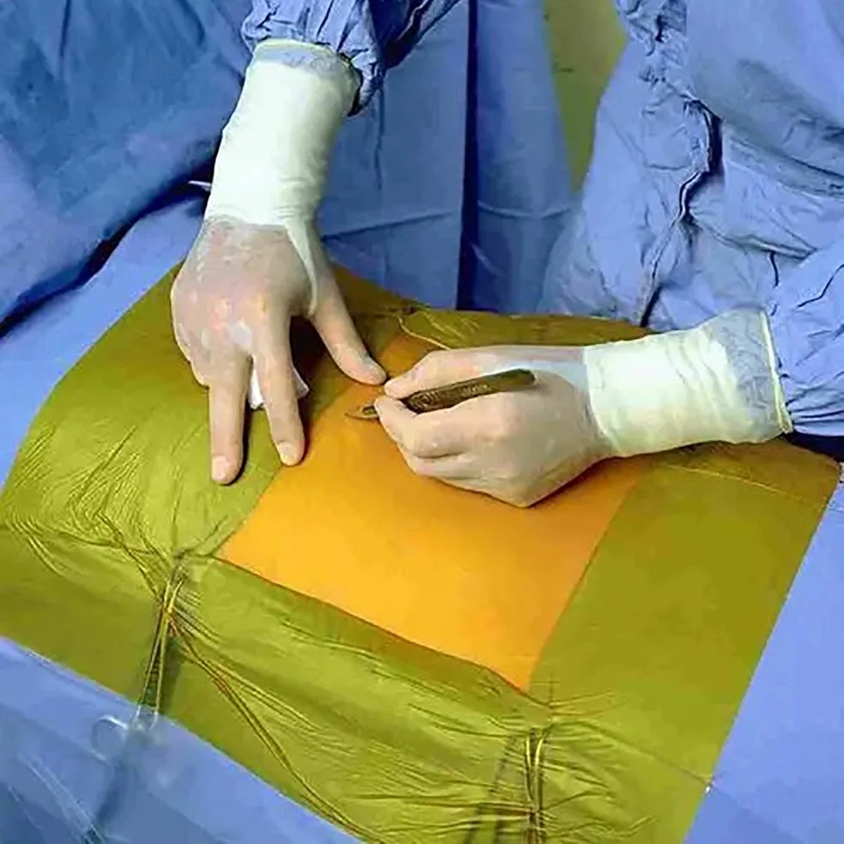 Iodine Incision Film Drape Surgical Dressing