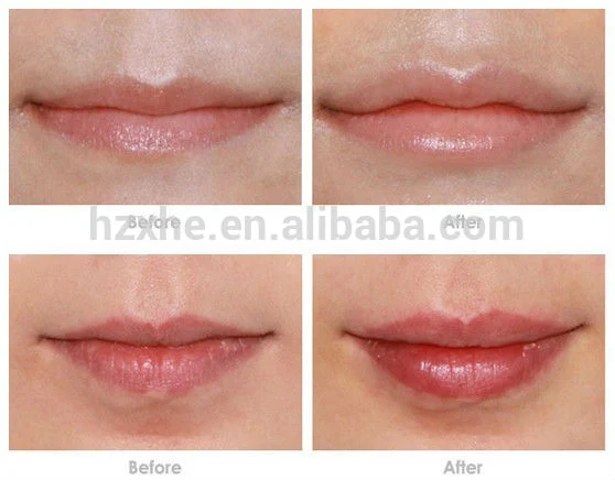 Good Biocompatibility Prefilled Hyaluronic Acid Ha Gel Dermal Filler with Lido and CE Marked