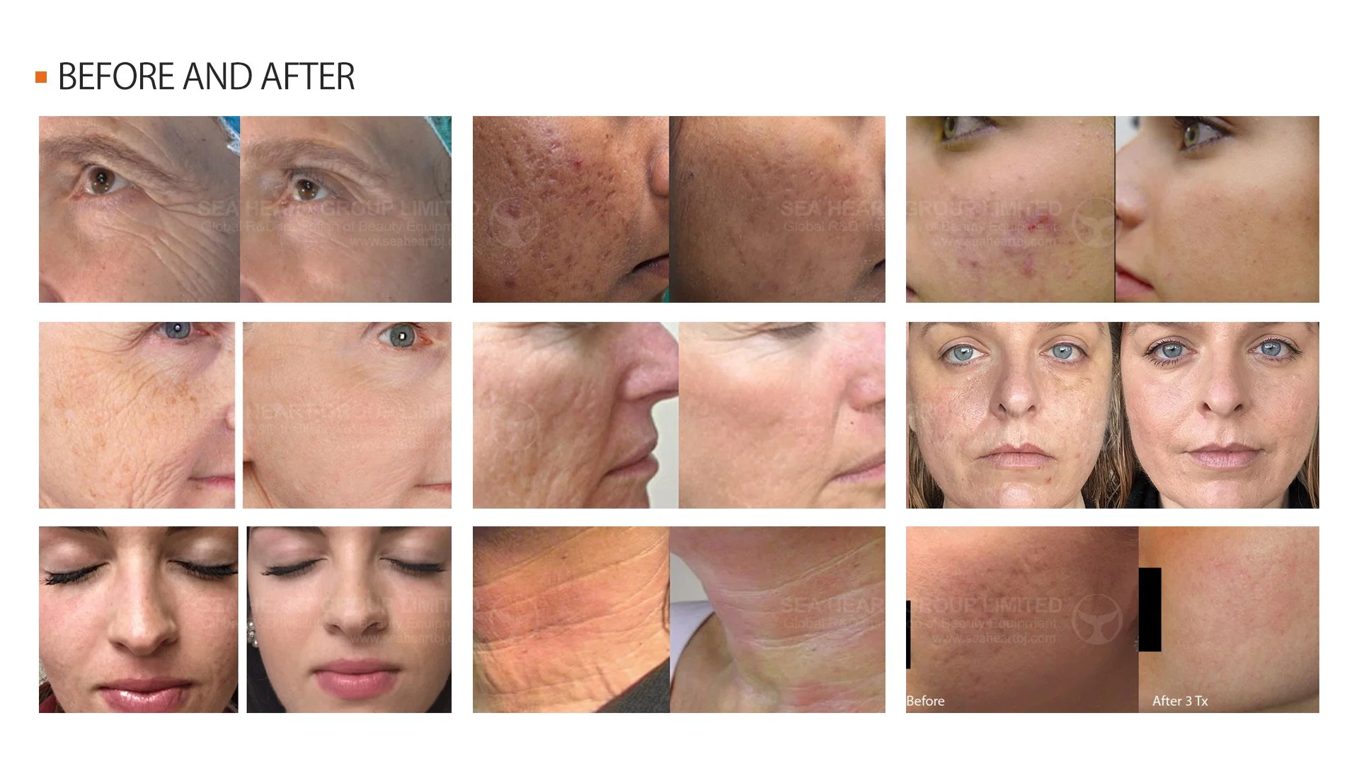 Professional Fractional System RF Microneedle for Skin Tightening