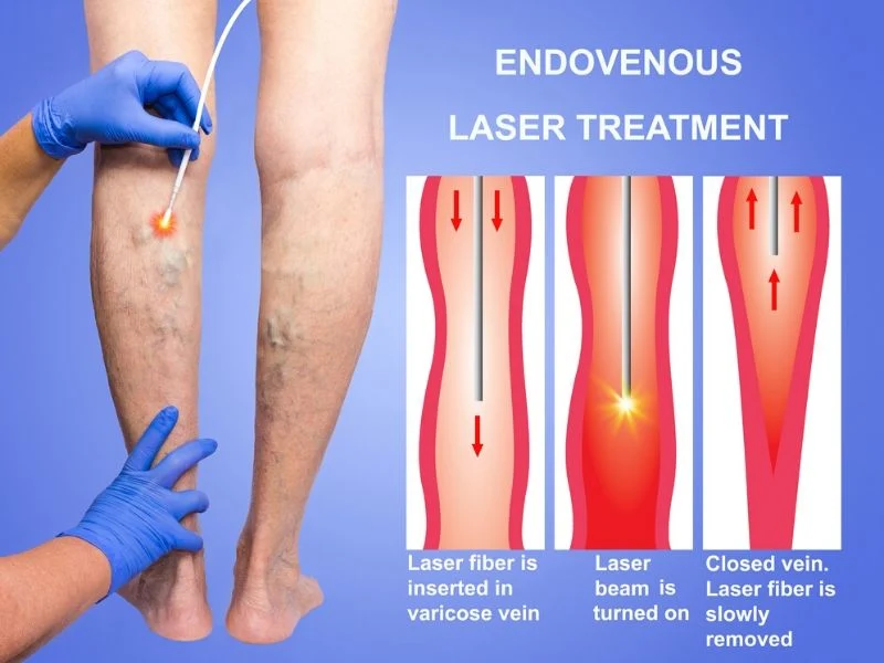 Flebologia Phlebologie Laser 1470nm Evla Gefäßchirurgie Laser Ablation Krampfadern Venen Evlt Laser Endovenöse Maschine