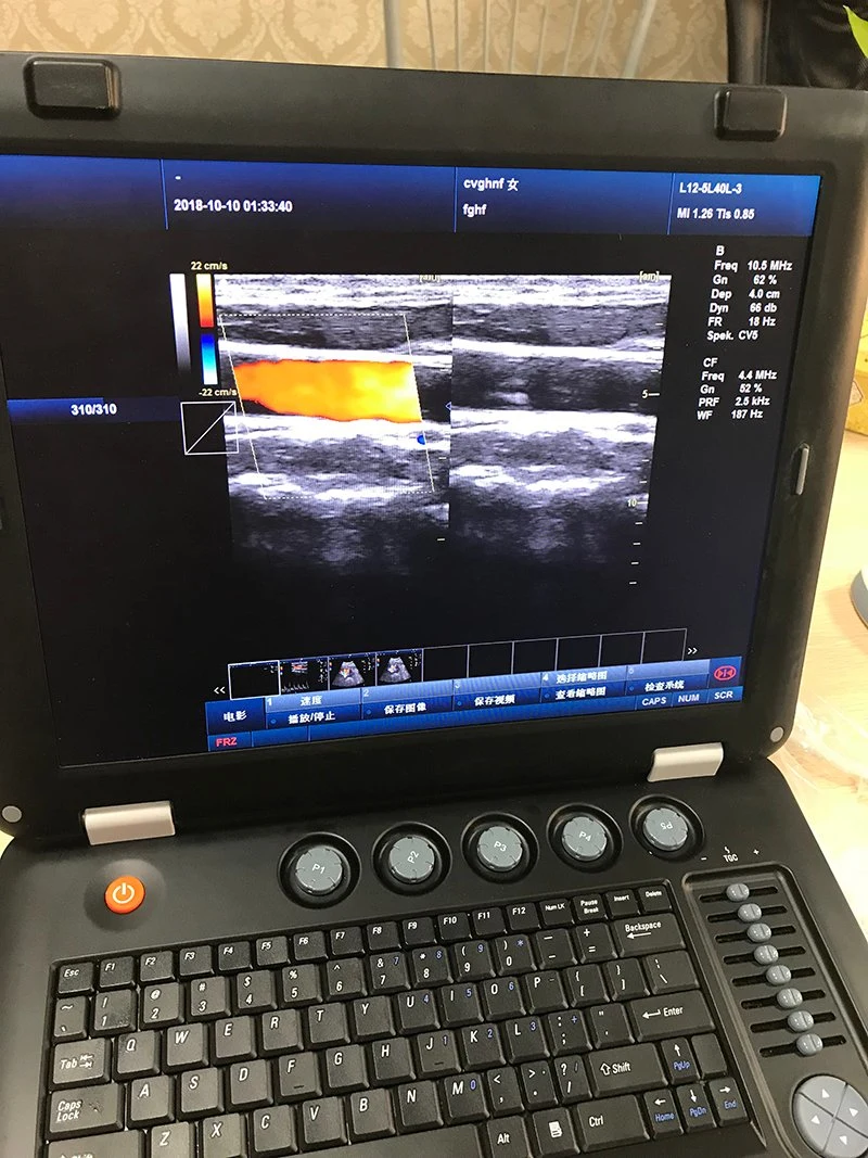 Low Cost Laptop Hospital 3D Color Doppler Ultrasound Scanner China