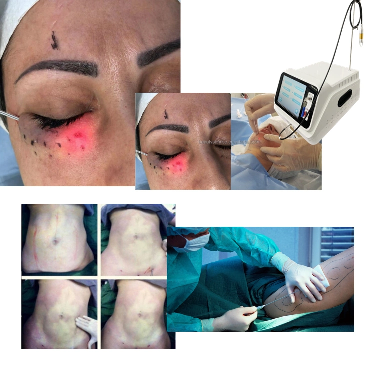 World Lightest Laser Diode Equipment with Special Designed 980 Nm Diode Fiber for Piles, Fistula & 1470 Nm Diode Fiber for Varicose Vein Medical Laser Beauty