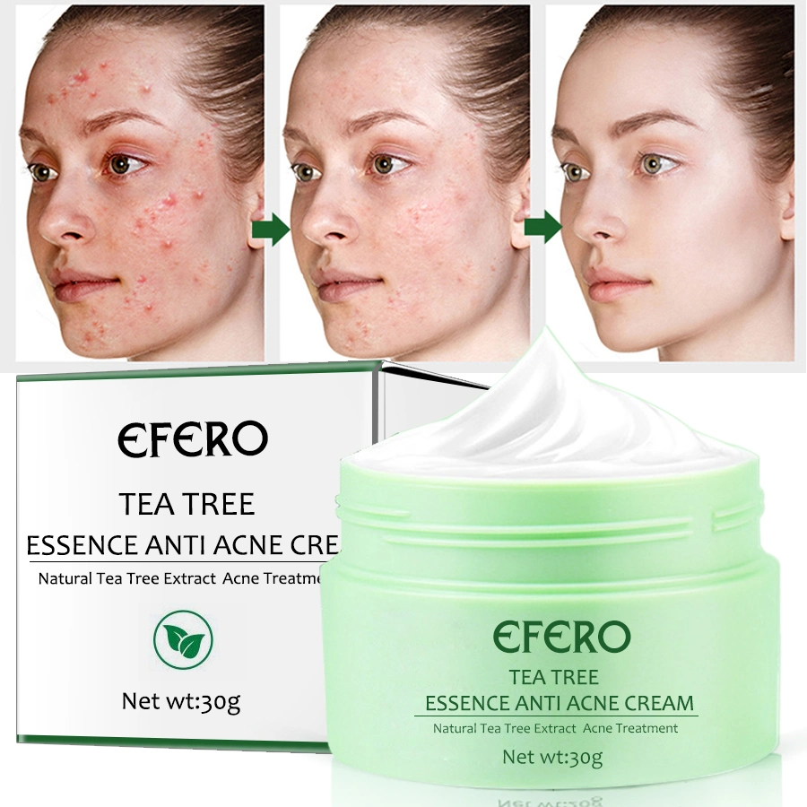 Tea Tree Acne Creme Hidratante cicatrizes cabeça negra extracção tratamento para acne pele creme embranquecimento gelado creme facial cuidado da pele