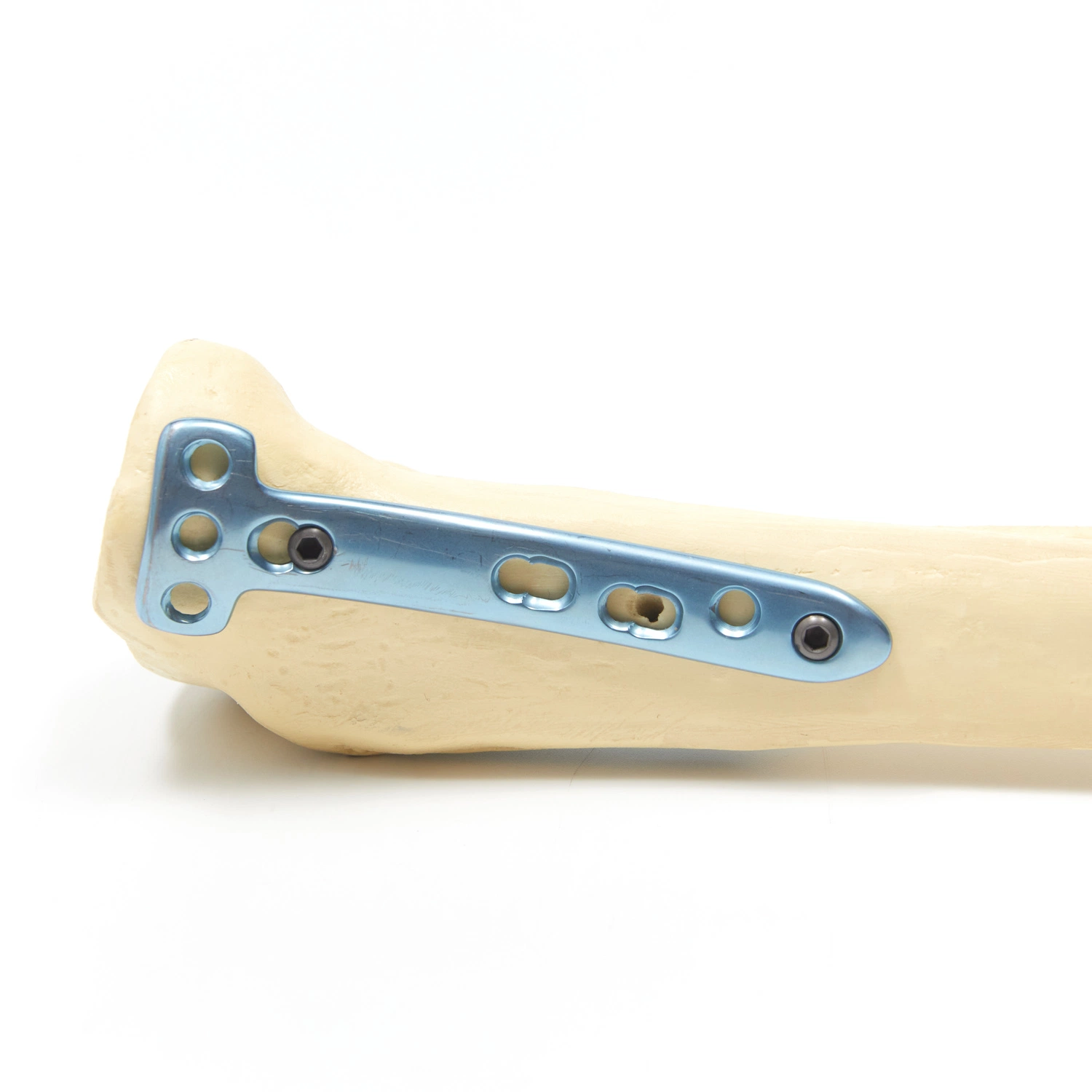 Medical Orthopaedic 5,0 Osteotomie Verriegelungsplatten Instrumentensatz