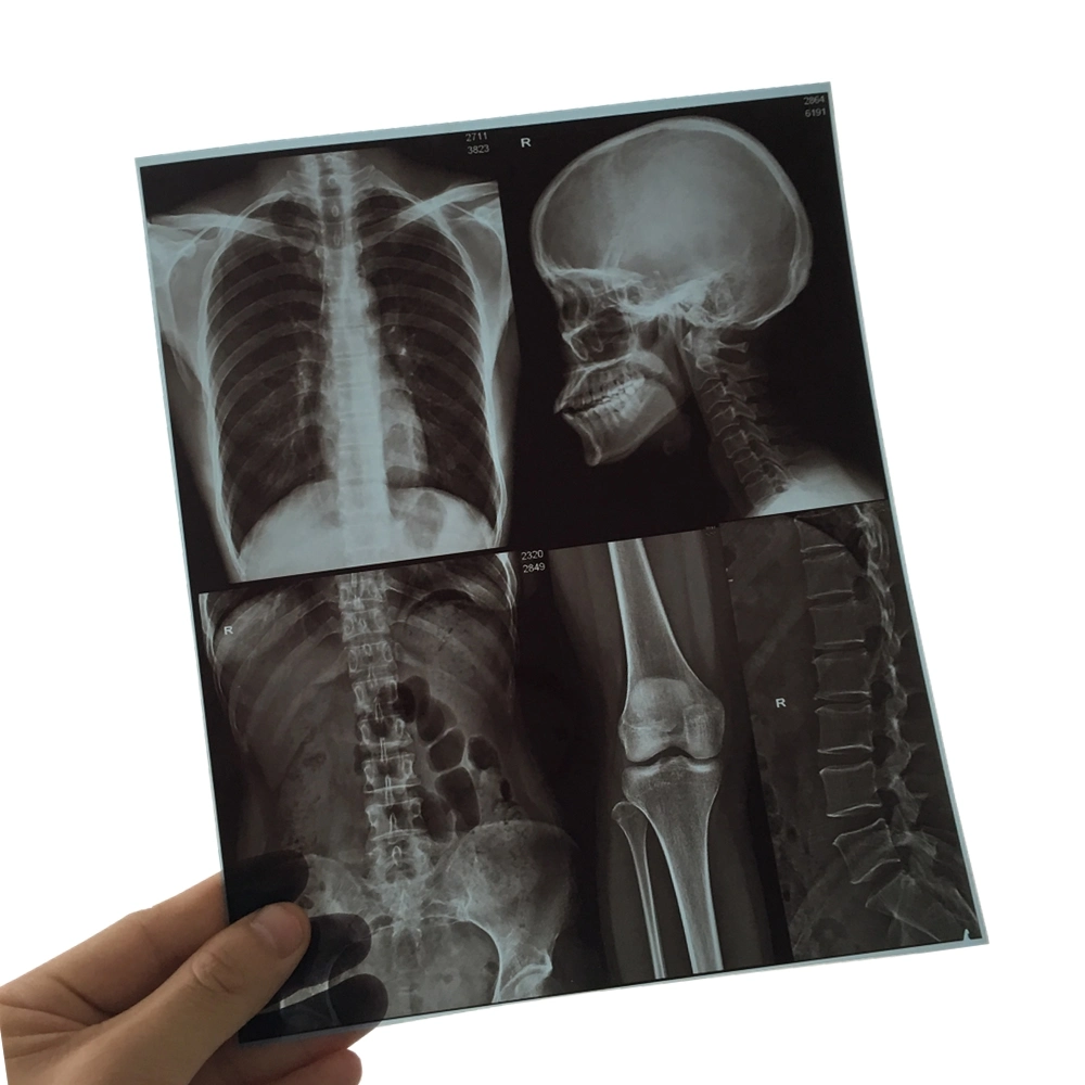 Digital Chest X-ray Films Inkjet Blue Image