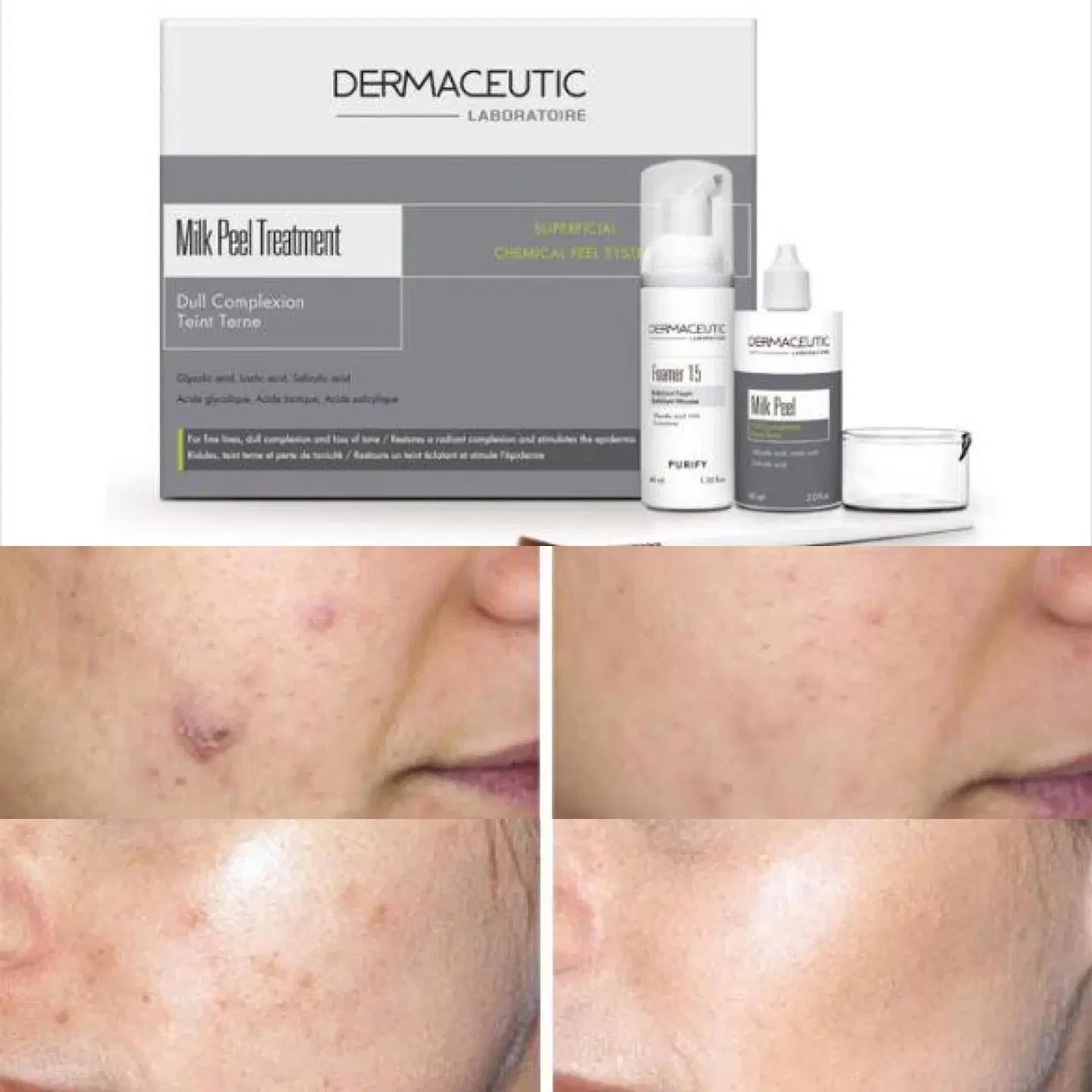 Dermaceutic Milk Peel Body Whitening e Lighten Acne Marks Making A pele brilhante Glutax branqueamento da pele