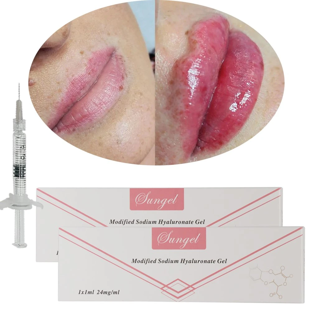 Skin Facial Plastic Injection Wholesale/Supplier Hyaluronic Filler Cross Linked Dermal Lip Correction Filler with Lidocaine