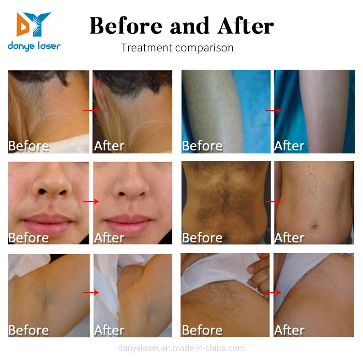 3 Wavelength Hair Removal Диод Лазерная косметика машина 3000 Вт Ice Депилакион