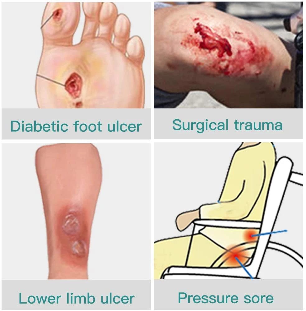 OEM Accept Chinese Manufacture Excellent Medical Alginate Hydrocolloid Wound Care Dressing