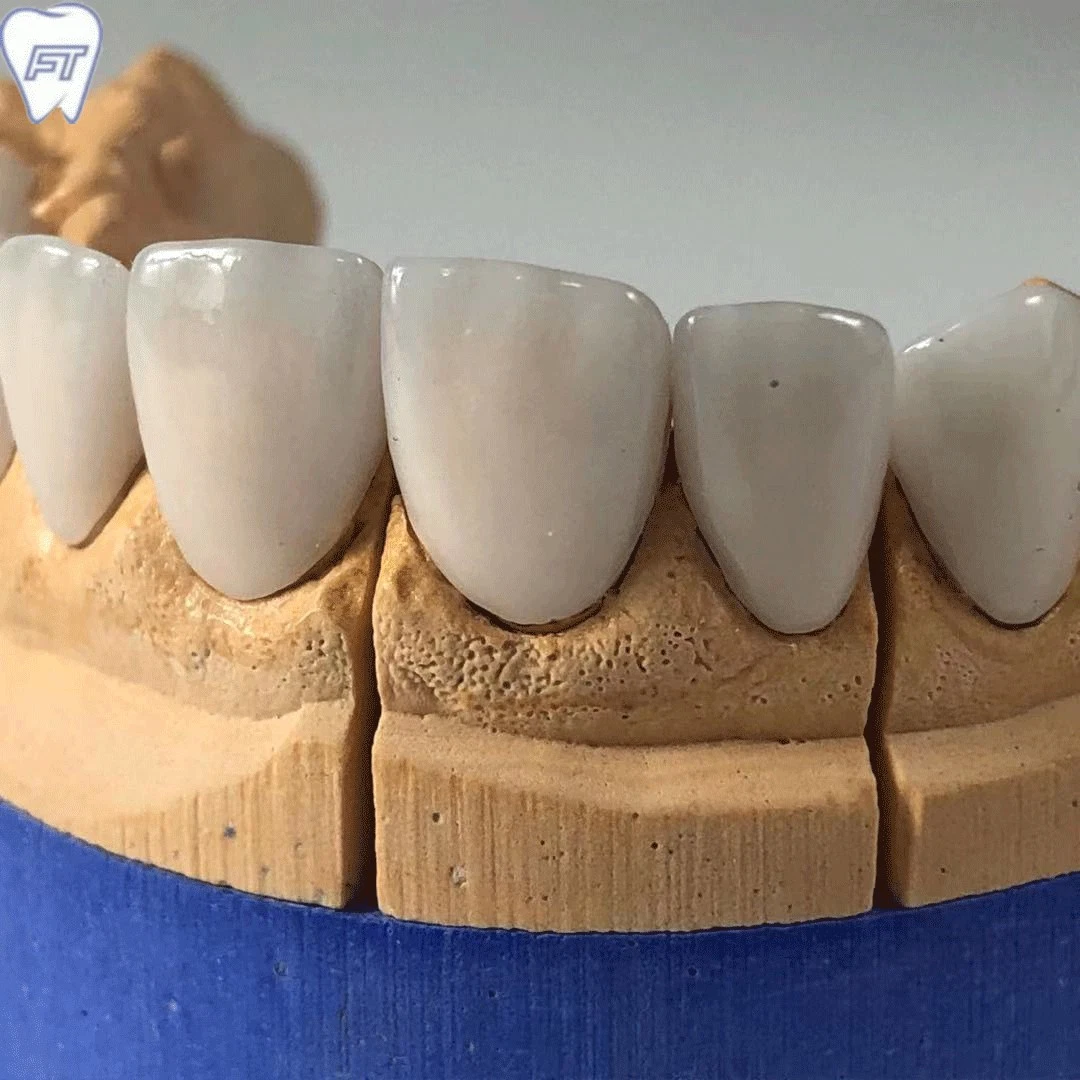 Les revêtements réalisés en Chine Dentaire Dental Lab avec de très haute qualité et Aestheic