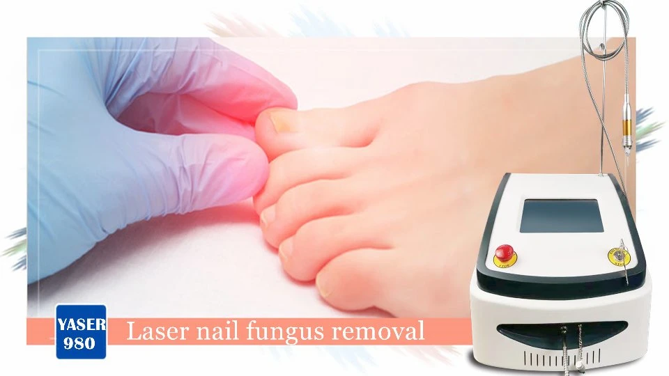 Mejor Venta 980nm Diodo Laser Nails Fungus tratamiento Fisioterapia plantar Eliminación de verrugas