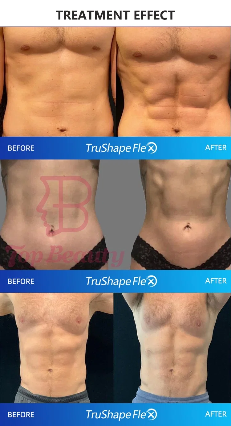 RF grasa ardiente adelgazante Trusculpt ID máquina Trusculpt ID Flex Máquina 2023 Peso de la piel Peso perdido cuerpo moldeando Trusculpt