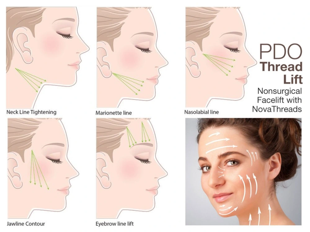 Белый Absorbable Pcl отмены потока