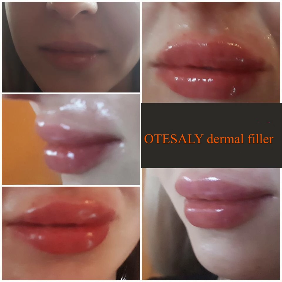 Wholesale Price Otesaly Derm Lines Ha Filler Injectable Temple Filling Dermal Injection Long Lasting Hyaluronic Acid Filler