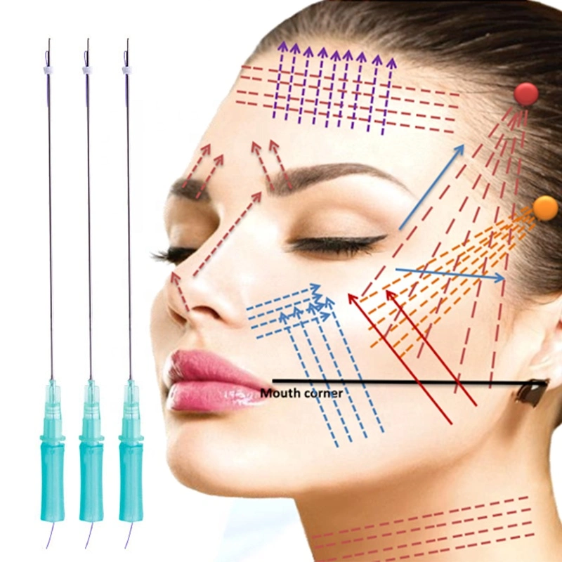 Pdo/Pcl/Plla Non Surgical Face Lifting Suture Thread with Needle/Cannula for Facelift