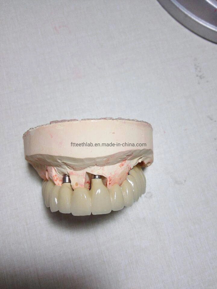 Full House Implant Bridge Made From Chinese Dental Lab