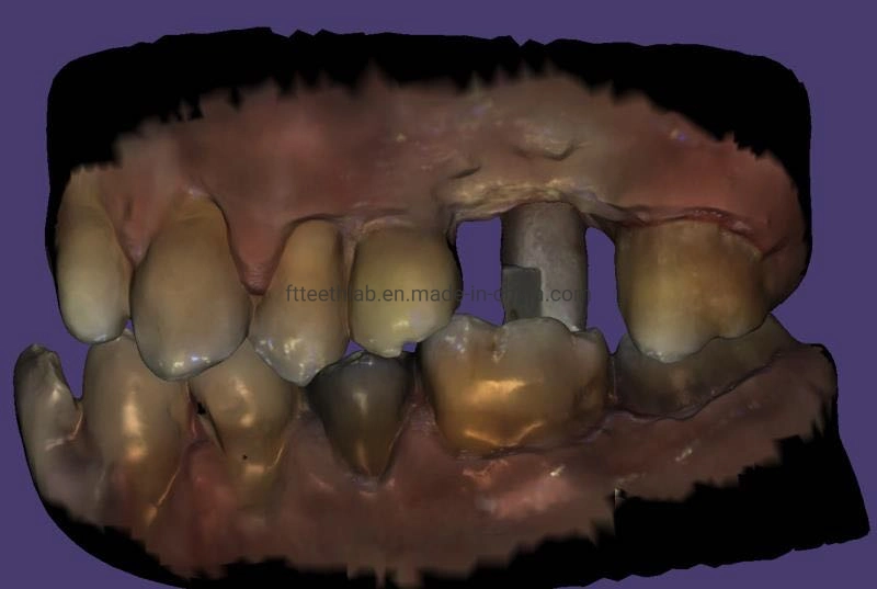 Implant dentaire couronnes en céramique de métal et le pont de la Chine