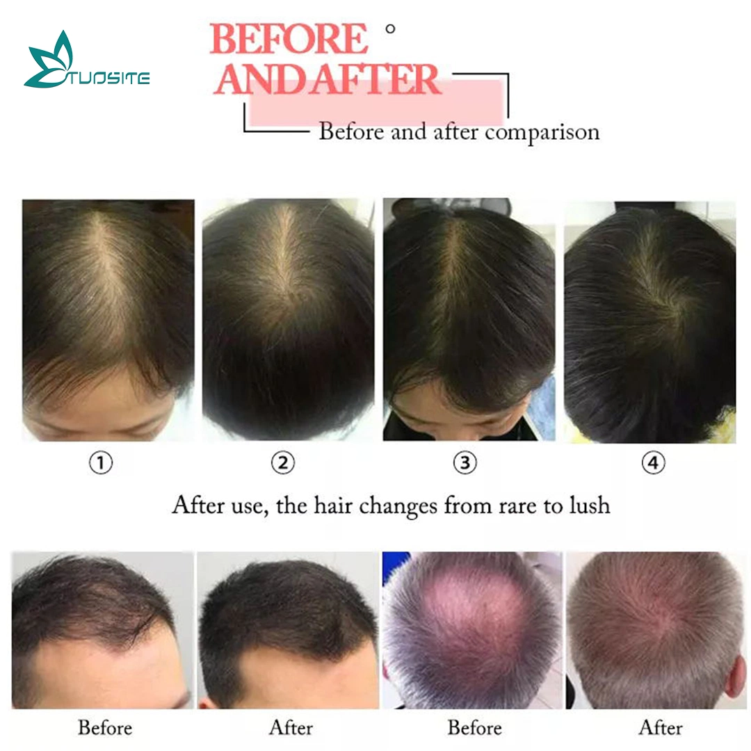 Regrowth Anti Hair Loss Alopecia Areata Low Level Laser Light Therapy for Hair Growth