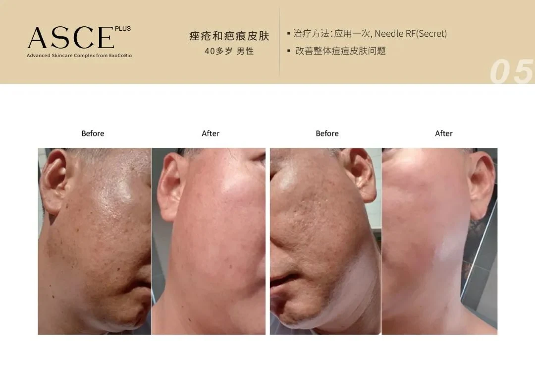 Asce+ Human Stem Cell Derma Signal Kit Skincare Fights Aging and Eliminates Acne Marks and Dull Blemishes Asce Plus Derma Signal Kit Srlv-S Exosome