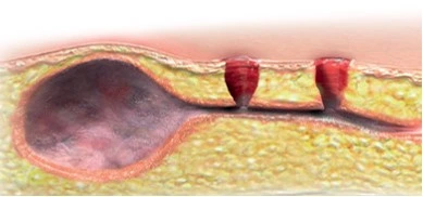 980nm Диод Лазерные паучья Veins Removal 1470 Хеморроидная обработка 47Ватт