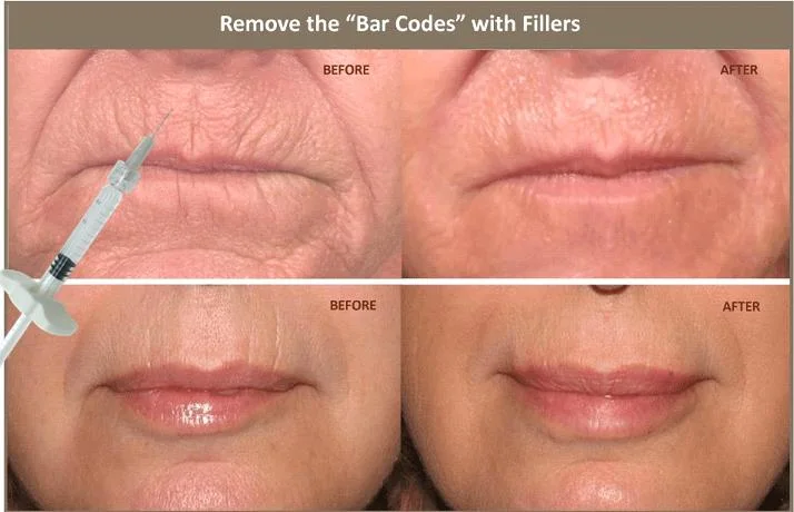 Cross Linked Hyaluronic Acid Dermal Filler for Correcting Facial Defects